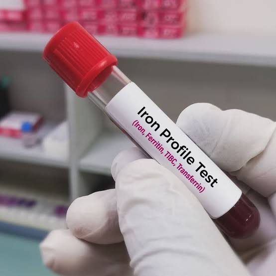 Iron Profile (Iron,Ferritin,TIBC,Transferrin,Saturation)