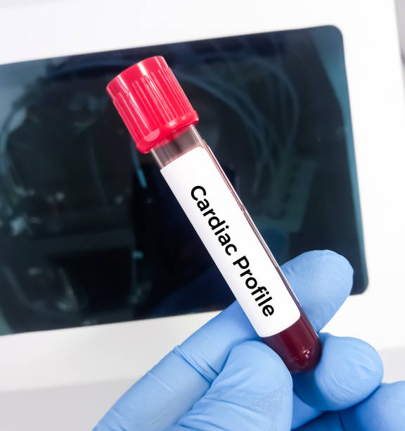Cardiac Profile - Trop I, CPK, CK - MB