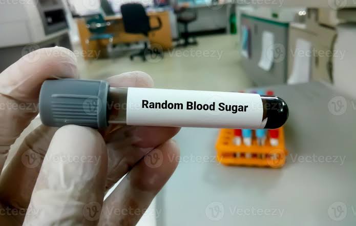 Random Blood Sugar (RBS)