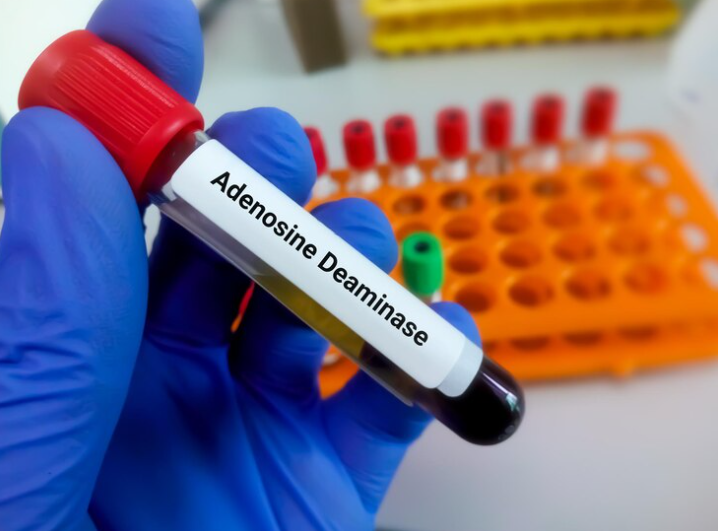 Adenosine deaminase (ADA)