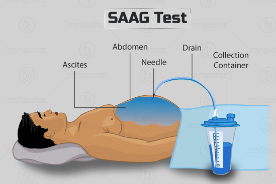 Serum - Ascites Albumin Gradient (SAAG)