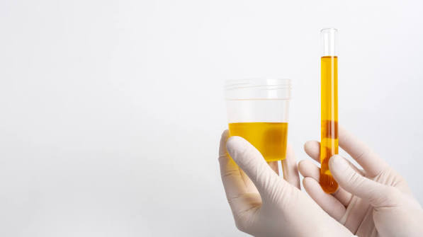 24 Hour Urine Total Protein (UTP)