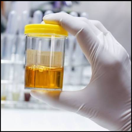 Urine Total Protein