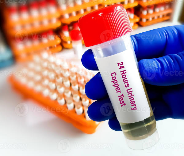 24 - Hour Urinary Copper