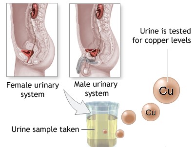 Urine Copper (Cu)