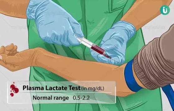 Plasma Lactate / Lactic acid