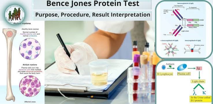 Bence - jones protein