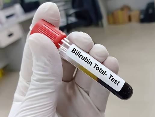 Bilirubin Total (Bili)