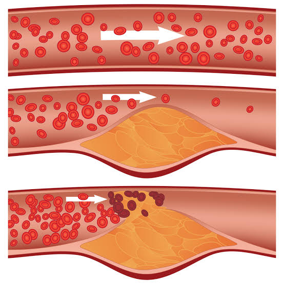 Cholestero (Chol)