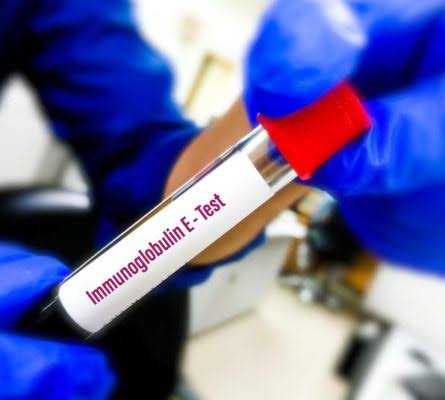 S. Total lgE ( Immunoglobulin E)