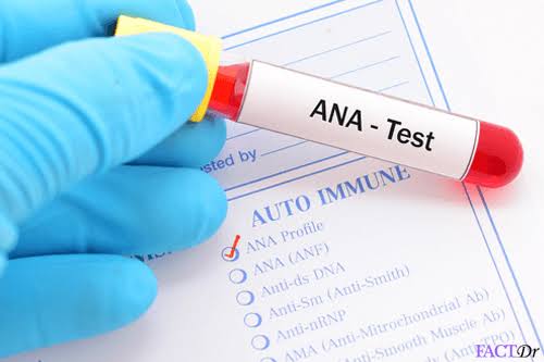 ANA ( Anti - Nuclear Antibody )/ANF