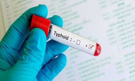 Salmonella typhi lgM & lgG / Typhoid lgM & lgG