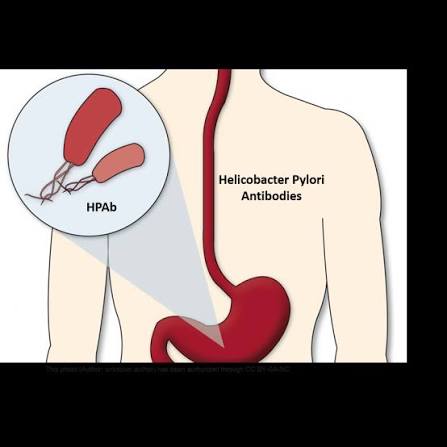 Anti H. Pylori antibody (Quantitative)
