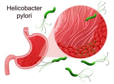 Anti H. Pylori lgA (Helicobacter pylori lgA)