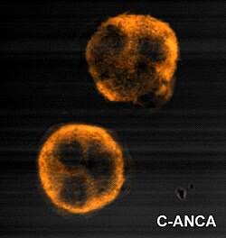 Anti - PR3 Ab (C-ANCA)
