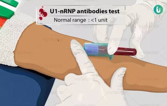 Anti- U1 RNP Antibody