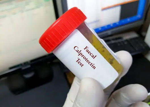 Calprotectin / Fecal Calprotectin