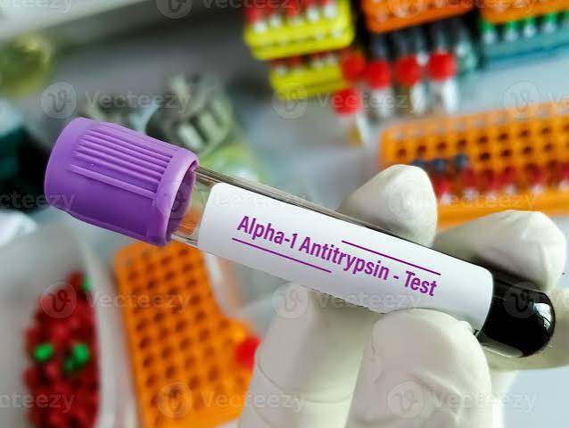 Alpha- 1 Antitrypsin