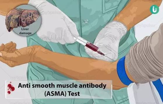 Anti Smooth Muscle Ab