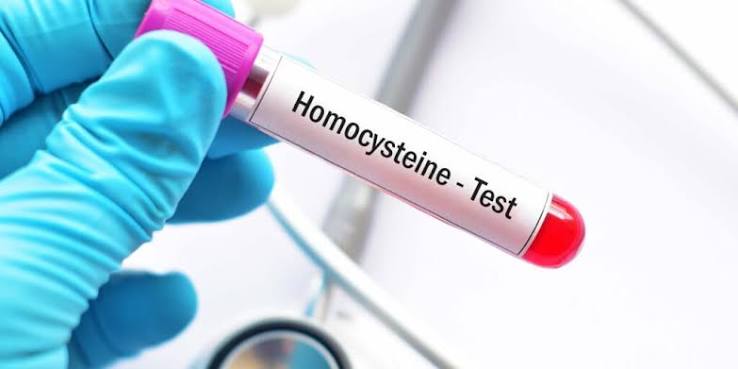 Homocysteine (Hcy)