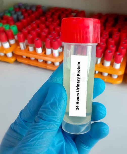 Urine Protein Electophoresis (24- Hour Urine)