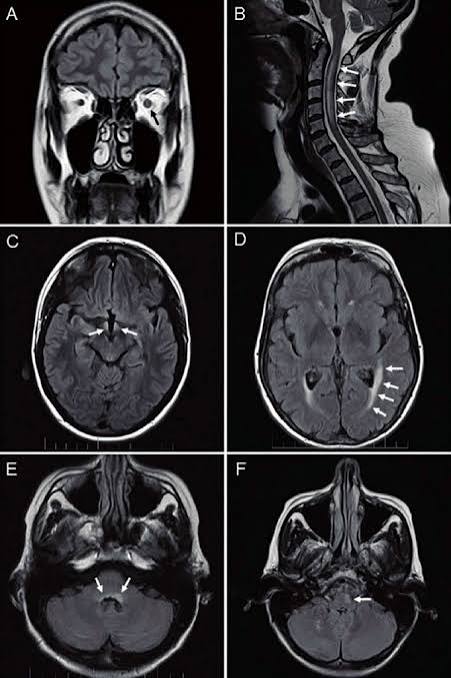 Anti-NMO (Neuromyelitis Optica) Panel