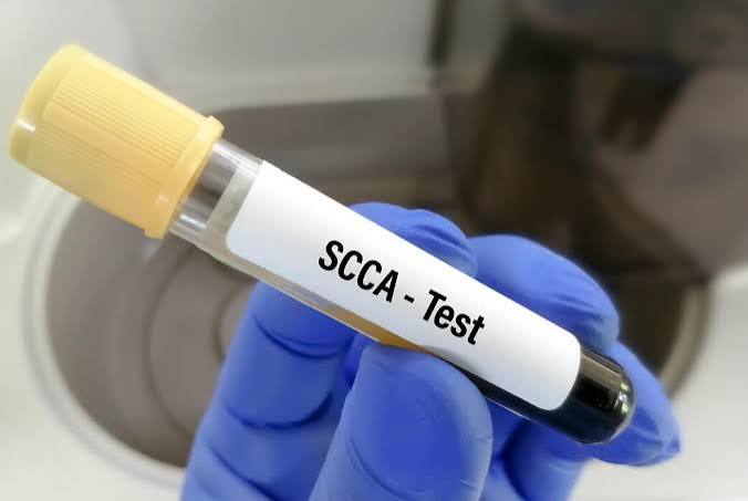 Squamous Cell Carcinoma Antigen (SCCA)