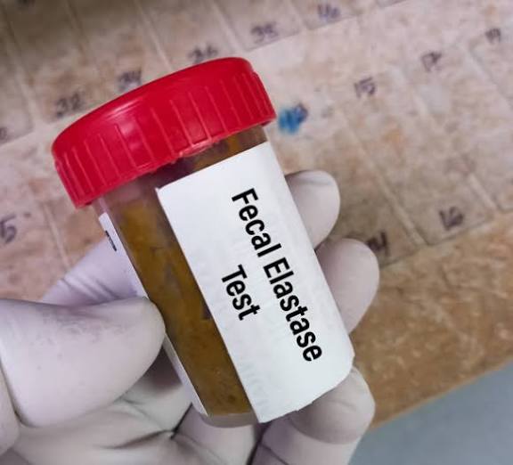 Fecal Pancreatic Elastase- 1 (FE-1)