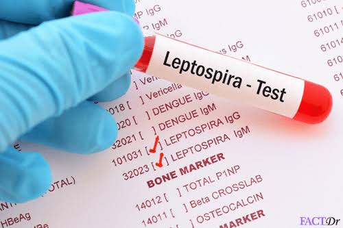 Leptospira Antibody (lgG & lgM)