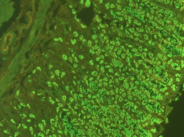 Anti- Parietal Cell Antibody (APCA)