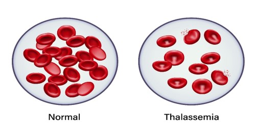 Thalassemia in Bangladesh Awareness, Prevention & Care
