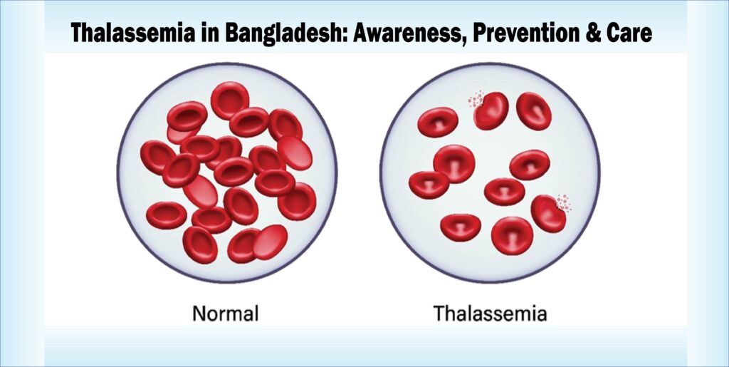 Thalassemia in Bangladesh: Awareness, Prevention & Care